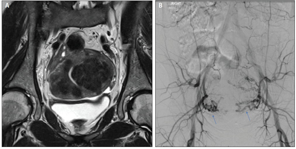 Currently Available Embolics For Uterine Fibroid Embolization