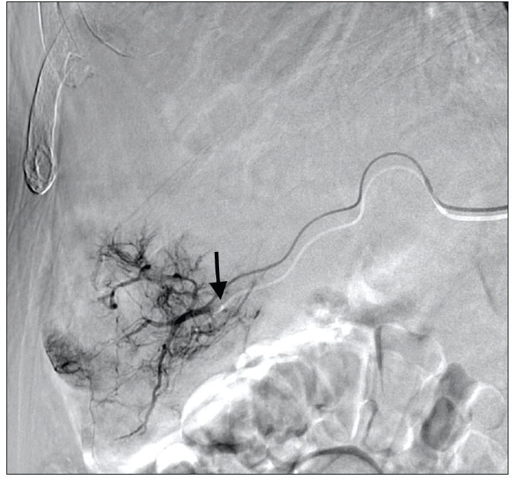 Transarterial Chemoembolization With The Sequre Microcatheter