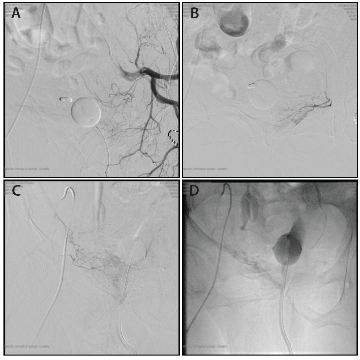 Prostate Artery Embolization Endovascular Today