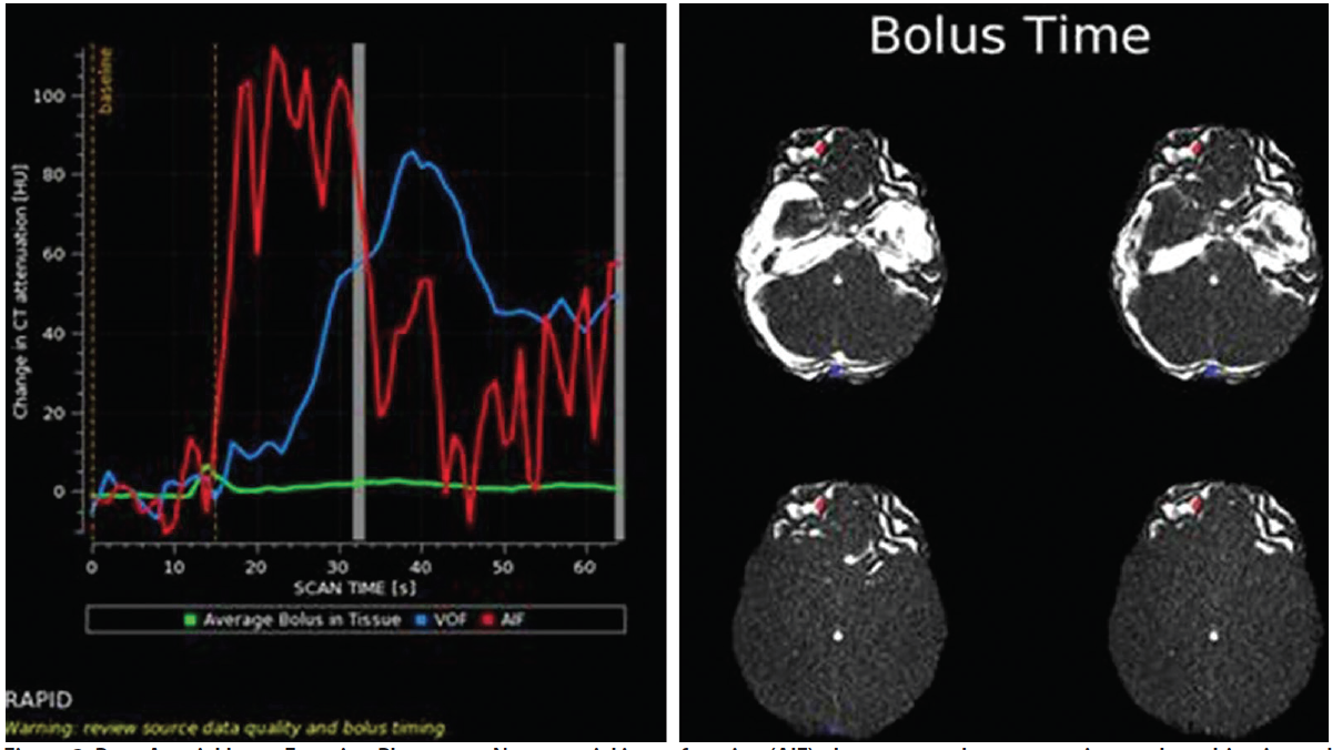 RAPID Automated CT Perfusion In Clinical Practice Practical Neurology