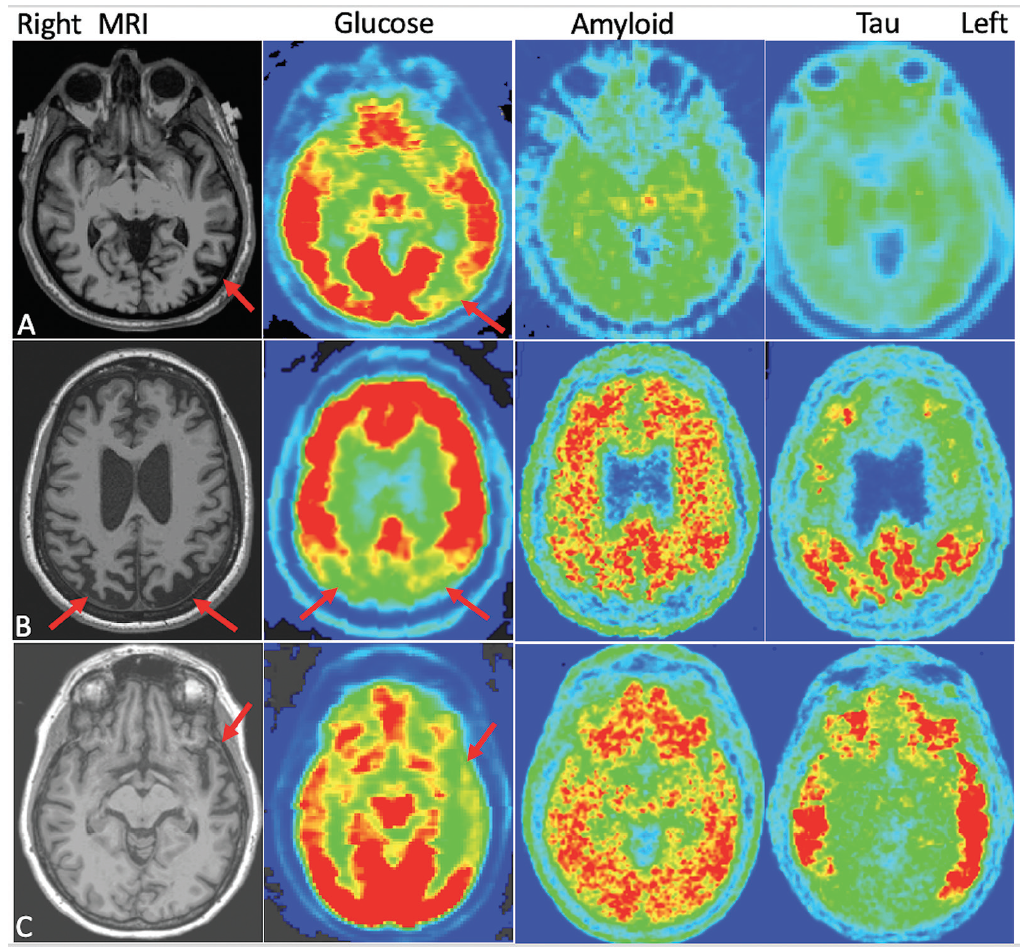 Molecular Imaging Biomarkers In Dementia Practical Neurology