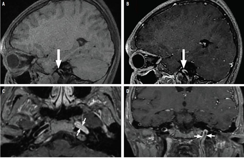 Stroke Snapshot Intracranial Mri Vessel Wall Imaging Practical Neurology