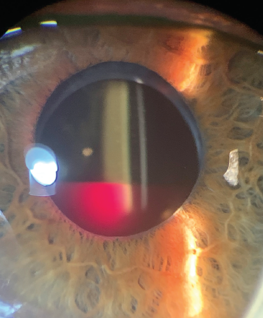 Endocapsular Hematoma Modern Optometry