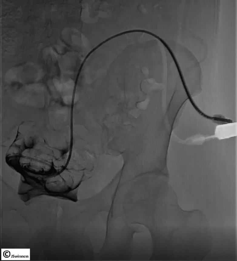 Modified Seldinger Peritoneal Dialysis Catheter Insertion A Game