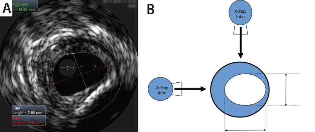 Optimizing Technique For Success A Guide For The Use Of IVUS In