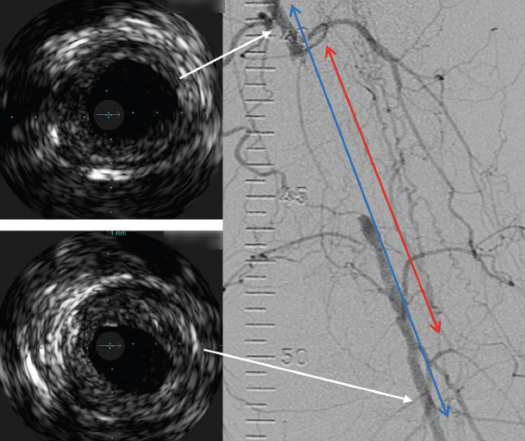 Optimizing Technique For Success A Guide For The Use Of IVUS In