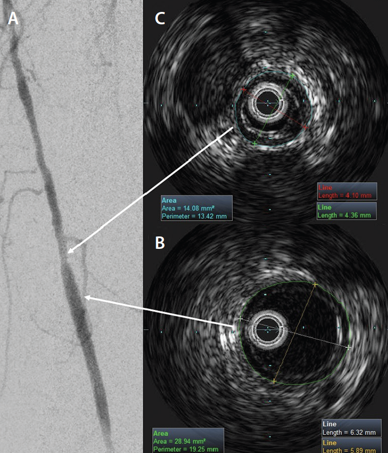 Optimizing Technique For Success A Guide For The Use Of Ivus In