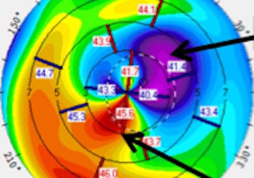 Collaborative Case #008: IOL Selection Challenge Thumb