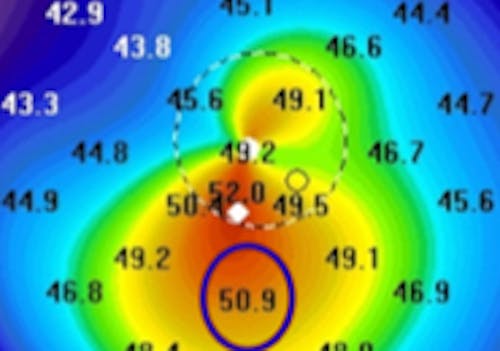 Collaborative Case #009: 1. Kantor N, Trattler W, Yazji A. Progressive keratoconus in older patients