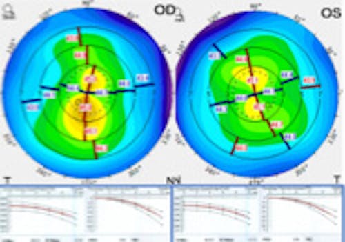 Collaborative Case #011 Treating Irregular Astigmatism After Laser Vision Correction thumb