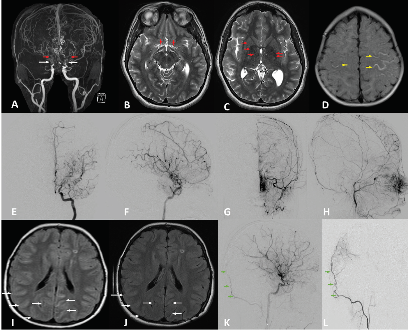 carotid artery brain prognosis