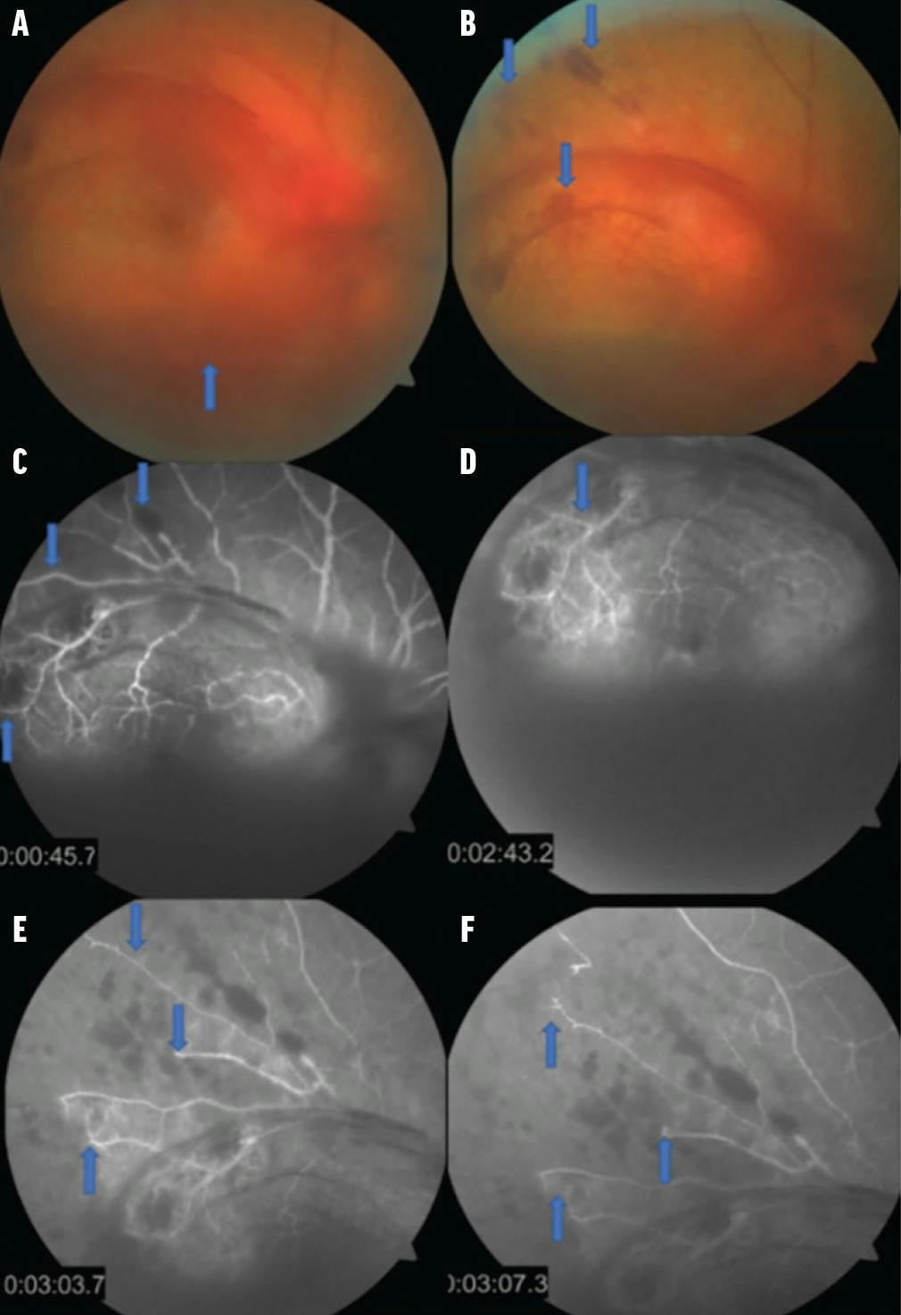 Managing The Ocular Effects of Steroid Overdose Retina Today