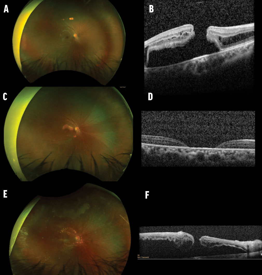 An Unusual Case of Pediatric IRD - Retina Today