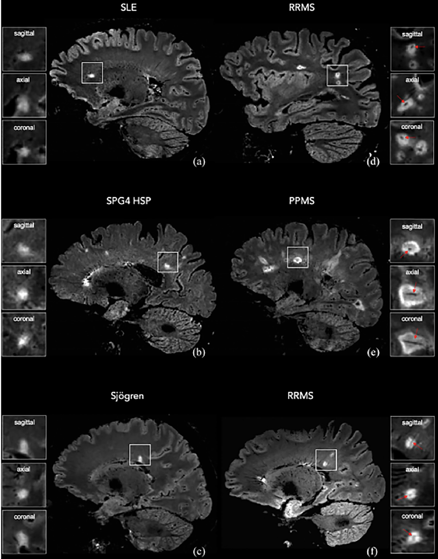 ms mri brain scan results
