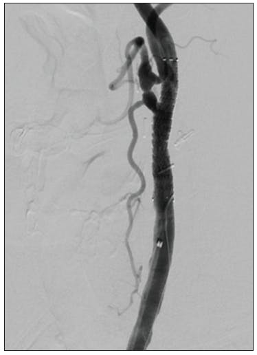The Benefits of Proximal Protection During Carotid Stenting The Benefits of Proximal Protection During Carotid Stenting