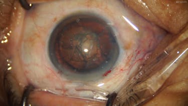 Four-Incision Phaco Chop and Other Phaco Complications thumbnail