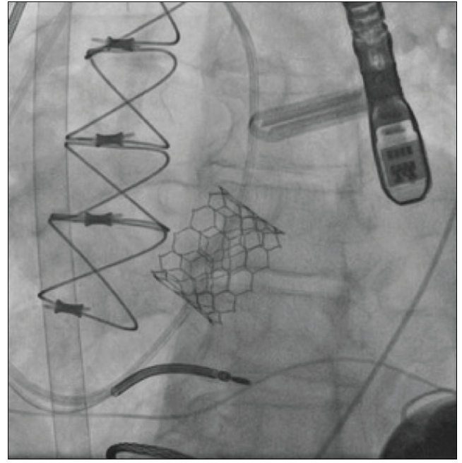 Tavr In Aortic Insufficiency Cardiac Interventions Today