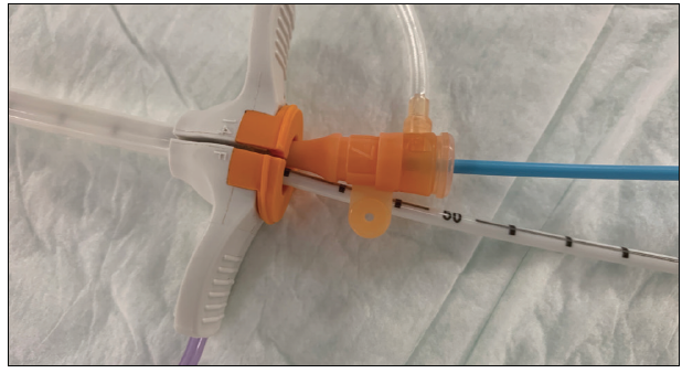 Single-Access Technique for Impella-Assisted High-Risk PCI - Cardiac ...