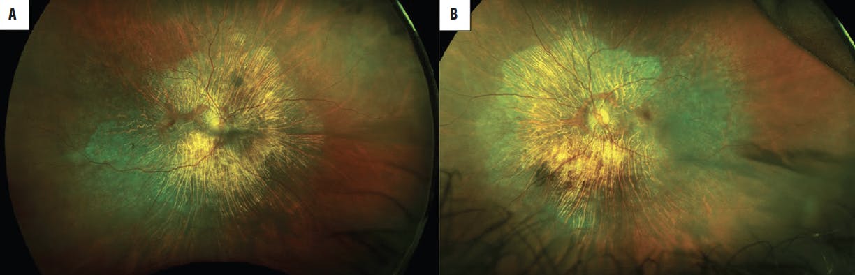 gabapentin retinal toxicity