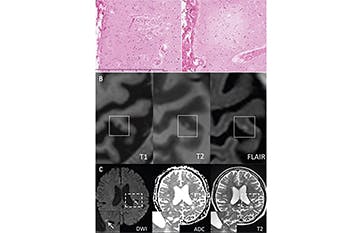 Stroke Snapshot: Cerebral Microinfarcts—Etiology and Clinical ...