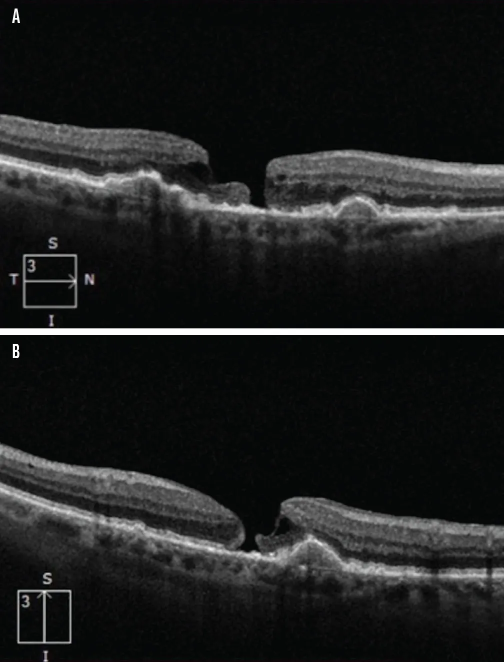 Spontaneous Closure of a Full-Thickness Macular Hole - Retina Today