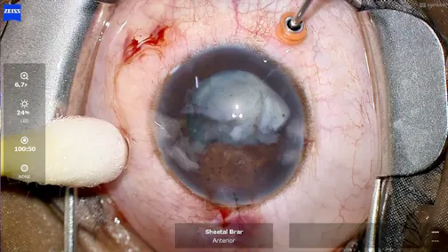 Fluid Misdirection in a Case of Posterior Polar Cataract