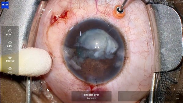 Fluid Misdirection in a Case of Posterior Polar Cataract thumbnail