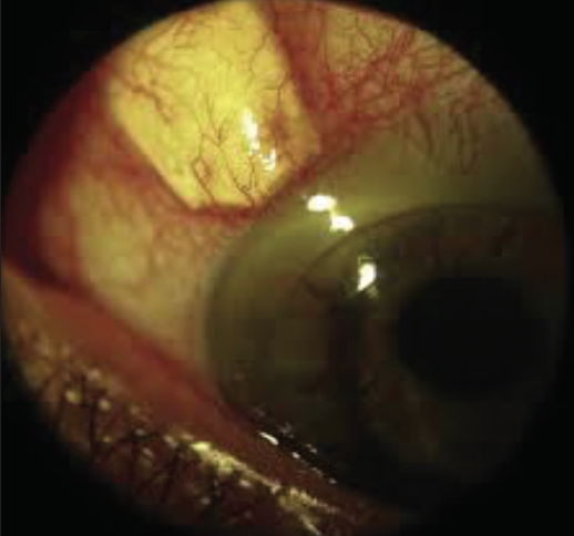 Cornea and Contact Lens Considerations in Glaucoma - Modern Optometry