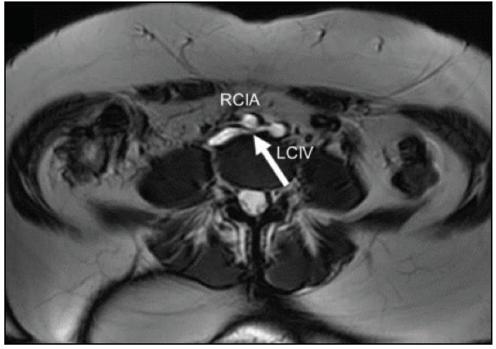 Pelvic Congestion Syndrome - North Star Vascular and Interventional