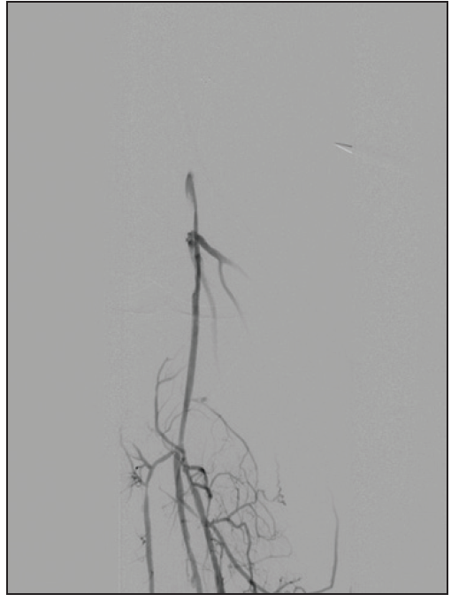 It Takes Two To Tango Leveraging Open And Endovascular Options For Treatment Of Critical Limb 6236