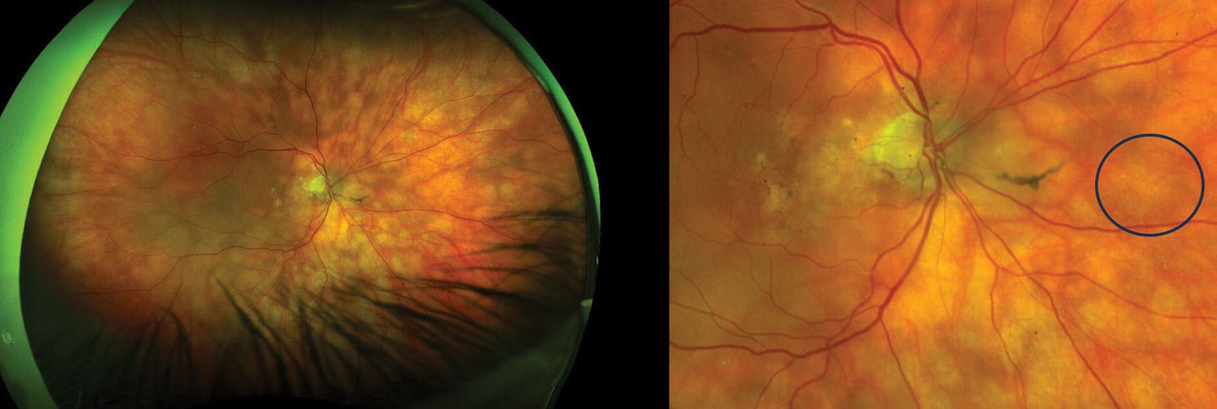 Uveal Reactive Lymphoid Hyperplasia - Retina Today