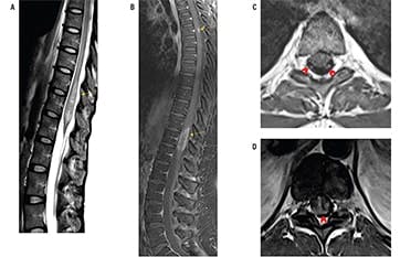 Neuromyelitis Optica Spectrum Disorder With Atypical Imaging Features ...