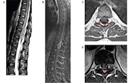 Neuromyelitis Optica Spectrum Disorder With Atypical Imaging Features image