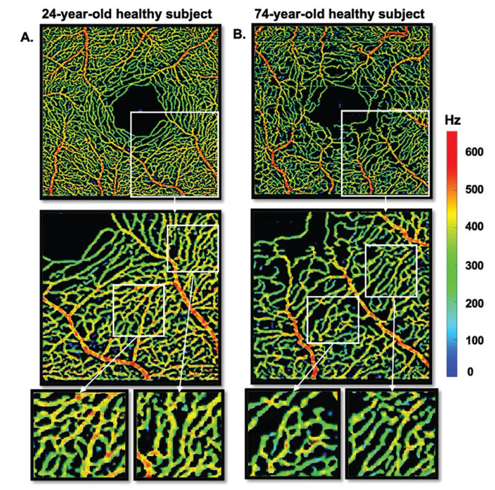 The Value of OCTA in Retinal Vascular Disease - Retina Today