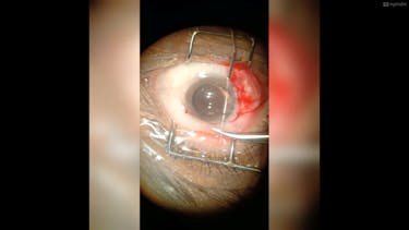 Complicated Phaco Case thumbnail