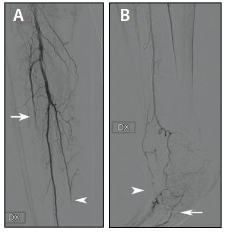 Case Report: Revascularizing BTK Occlusions Using the