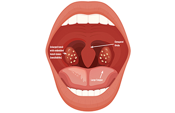 Tonsillectomy for the Treatment of Suspected Sleep Apnea with