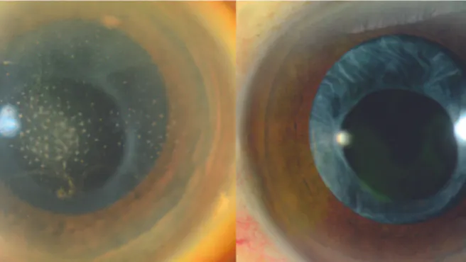 Treating Herpes Simplex and Varicella Anterior Uveitis image