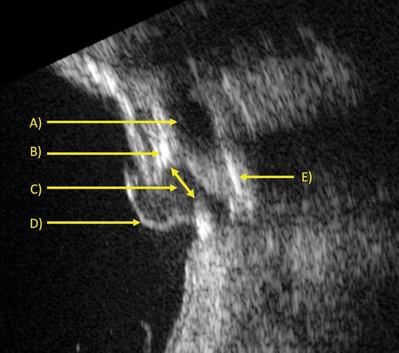 An Odd Case of Hypotony: The Value of Ultrasound image