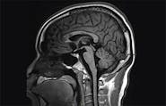 Investigation and Management of Confusion in an Individual With Diffuse Corpus Callosum Lesions image