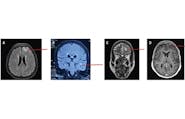 LGI1 Antibody Encephalitis Presenting as Focal Cortical Encephalitis image