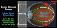 Myopia Control With Multifocal Contact Lenses Modern Optometry