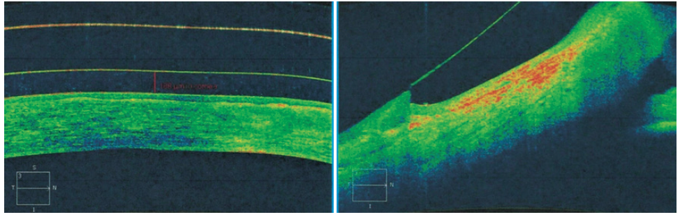 Managing Ocular Trauma With Scleral Lenses - Modern Optometry