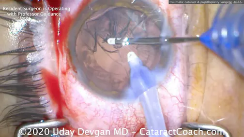 Traumatic Cataract and Pupilloplasty