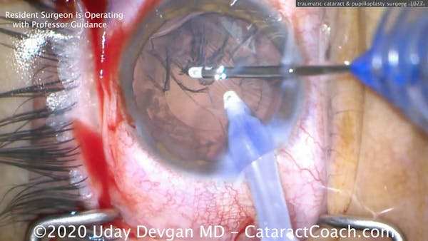 Traumatic Cataract and Pupilloplasty thumbnail