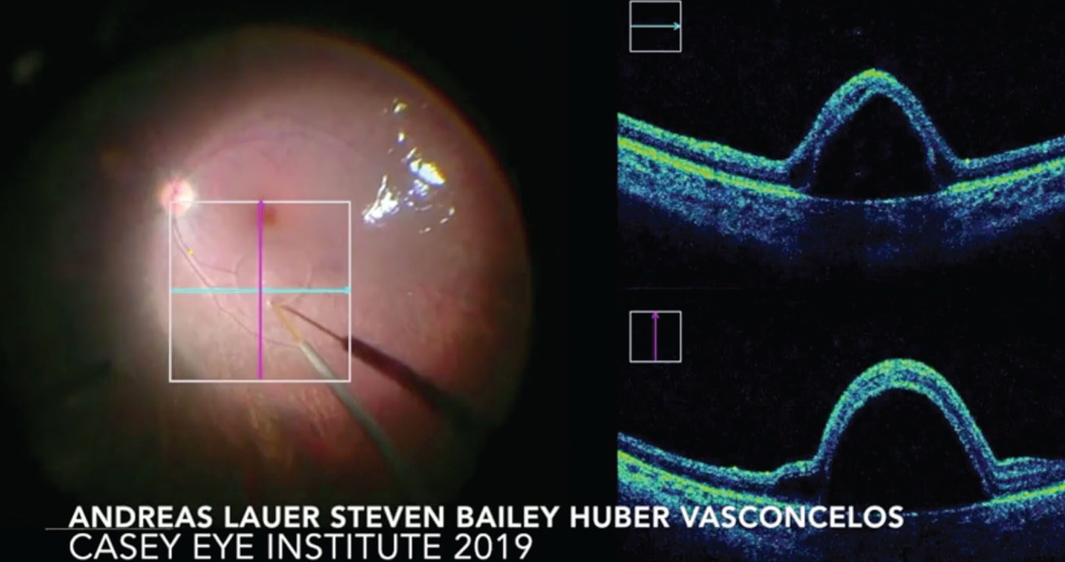 Let’s Talk About Gene Therapy For Inherited Retinal Diseases - Retina Today