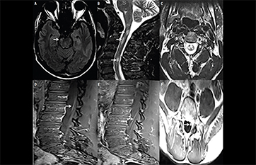 anti mog antibody disease anti mog antibody disease