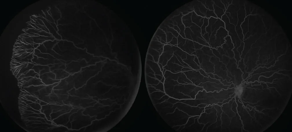 Imaging Tips and Tricks For Retinopathy of Prematurity - Retina Today