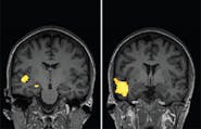 A Case of Anti–GAD65 Autoimmune Musicogenic Epilepsy image