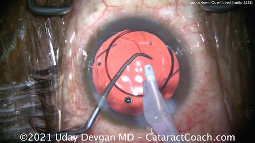 Upside-Down IOL With Bent Haptic